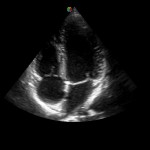 4 chamber view on Sonoscape S9